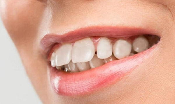Hình ảnh minh họa về răng hô