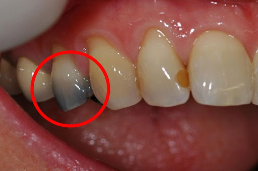 Dấu hiệu nhận biết sâu rặng nặng là tình trạng thay đổi màu sắc của răng