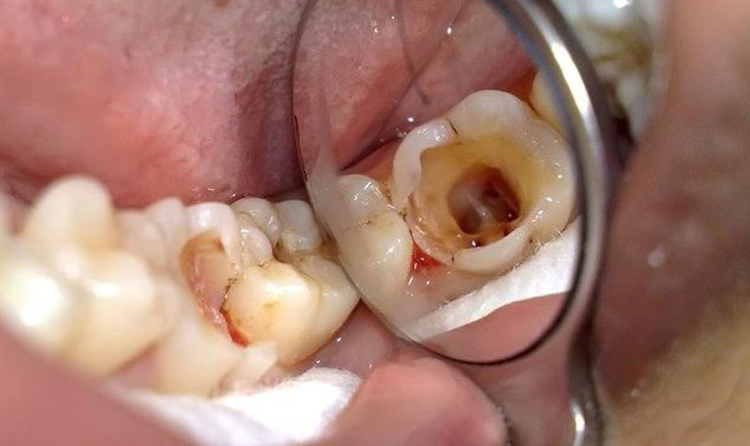Hình ảnh sâu răng độ 3 chữa trị tại Nha khoa SV quận 3