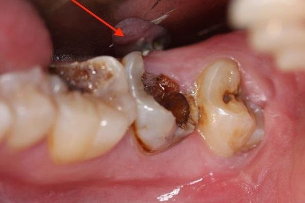 Hình ảnh răng số 7 bị sâu nặng