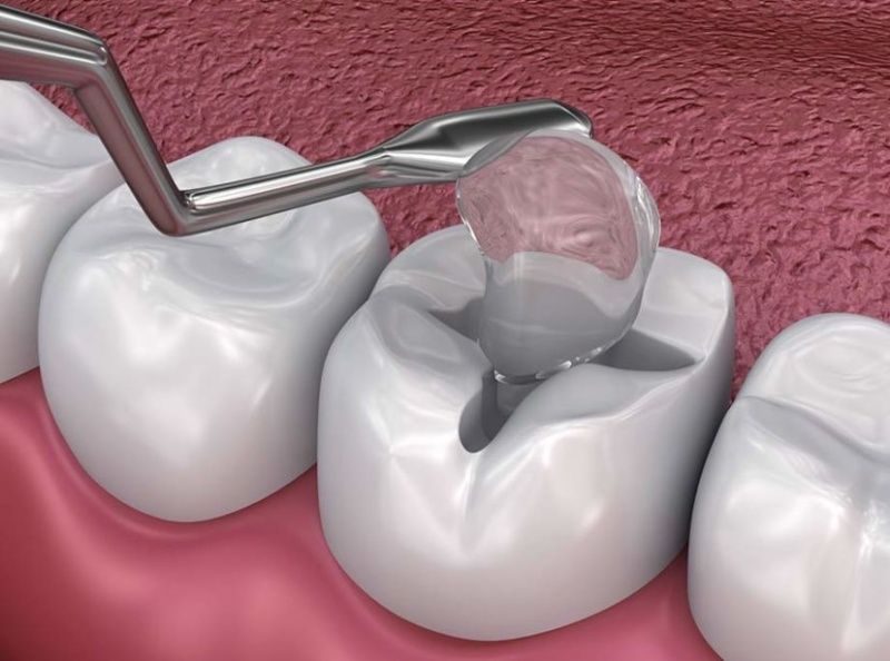 Nếu răng số 7 bị sâu, vẫn có thể trám hoặc làm Inlay/Onlay để giữ lại răng: Nha khoa SV quận 3