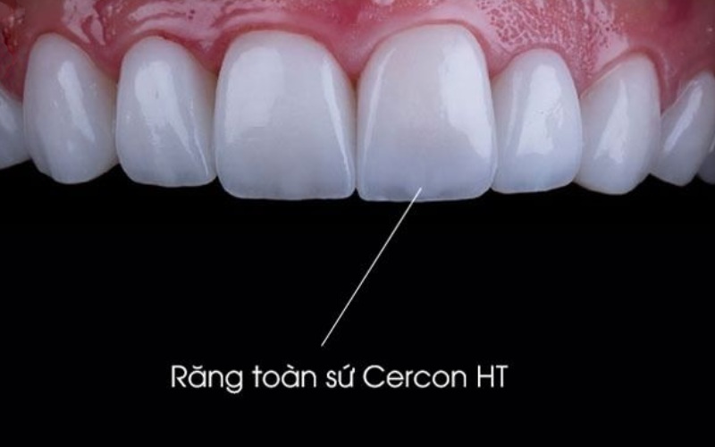 Hình nảh răng toàn sứ Cercon HT màu trắng trong