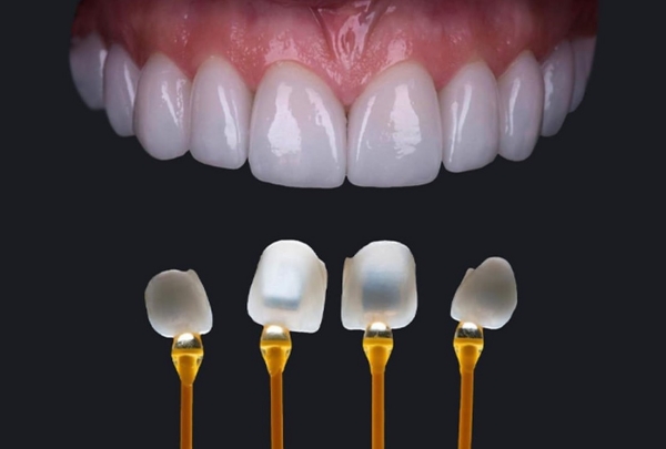 Hình ảnh giới thiệu mặt dán sứ Veneer Emax