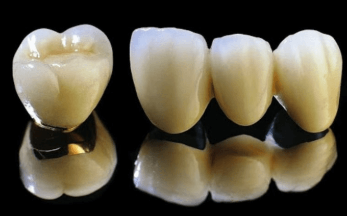 Hình ảnh về răng sứ kim loại thường