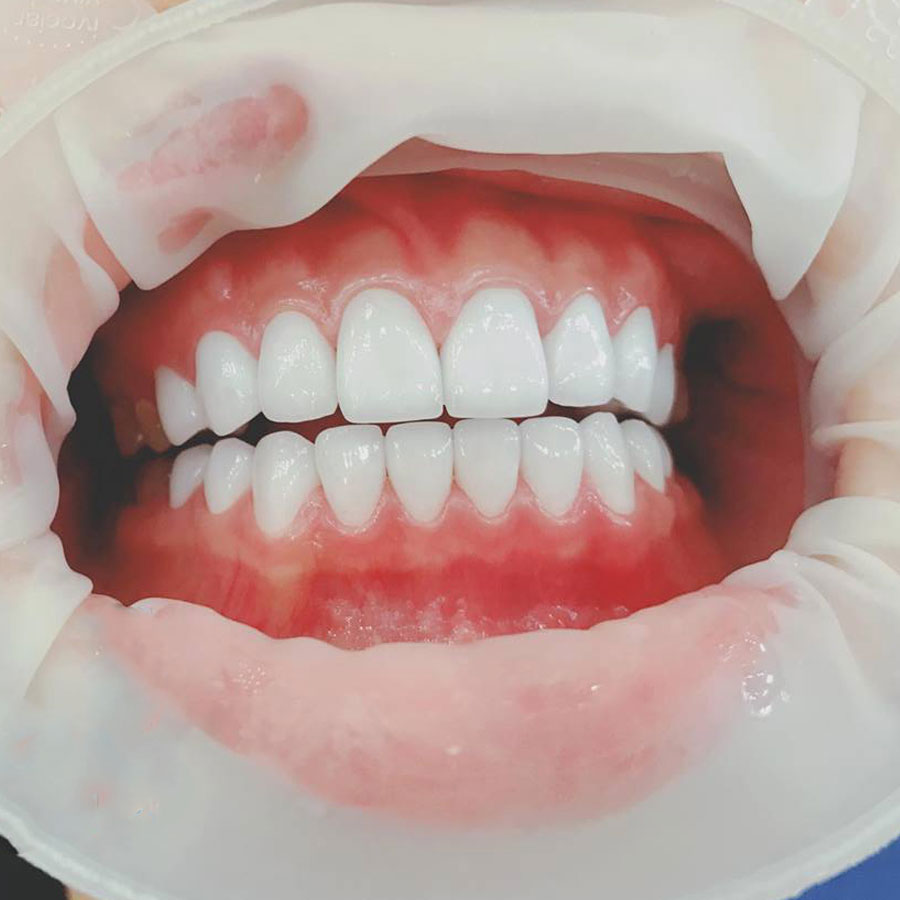 Răng sứ Lava Esthetic mang đến nhiều ưu điểm nổi bật