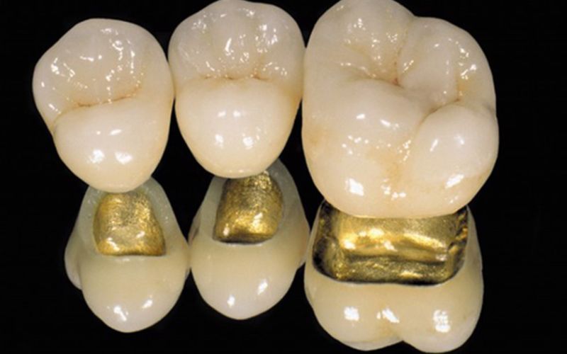 Hình ảnh về răng sứ kim loại quý