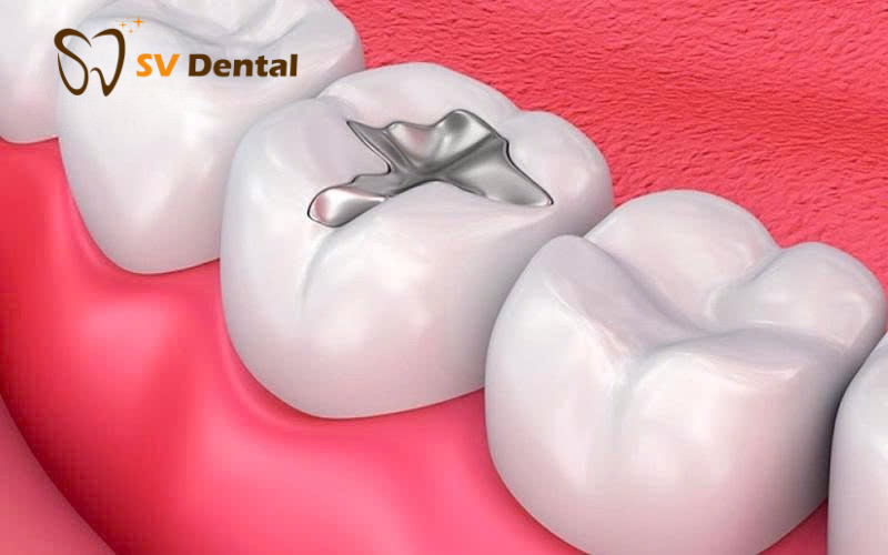 Vật Liệu Trám GIC Tại NHA KHOA SV 