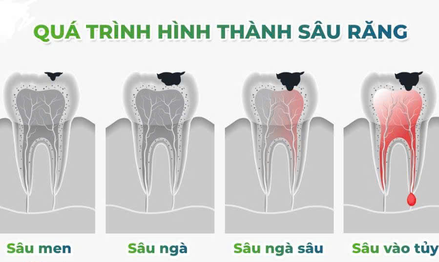 Hình ảnh các giai đoạn sâu răng -Nha Khoa SV