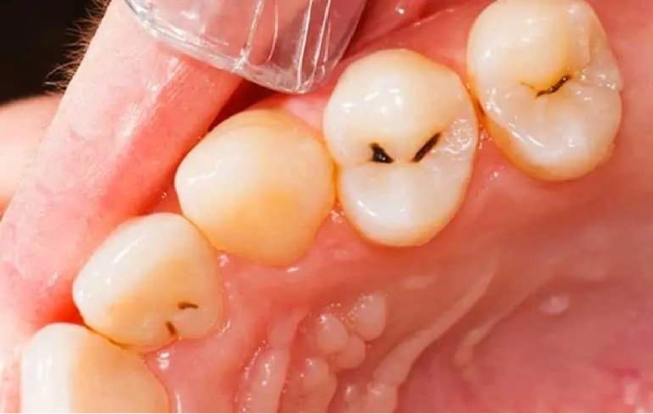Hình ảnh men sâu răng điều trị tại nha khoa SV