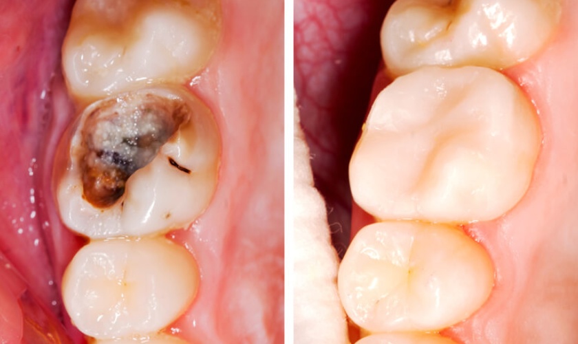 Hình ảnh răng sâu ngà nông và cách điều trị tại Nha khoa SV