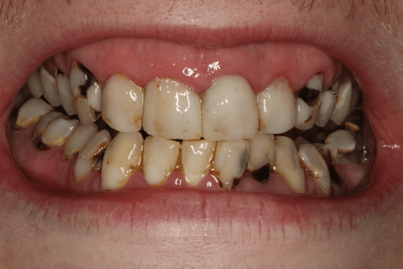 Vệ sinh răng miệng kém là nguyên nhân hàng đầu gây sâu răng