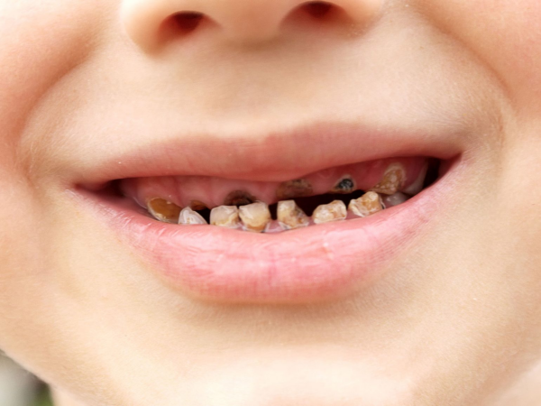 Hình ảnh minh họa tình trạng sâu răng ở trẻ em