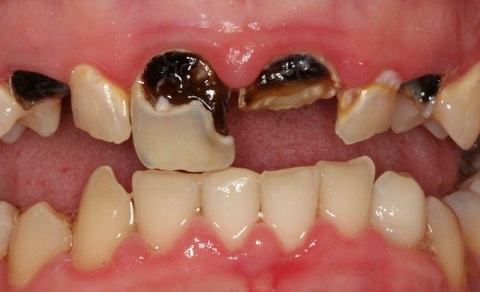 Hình ảnh chia sẻ kiến thức về sâu răng