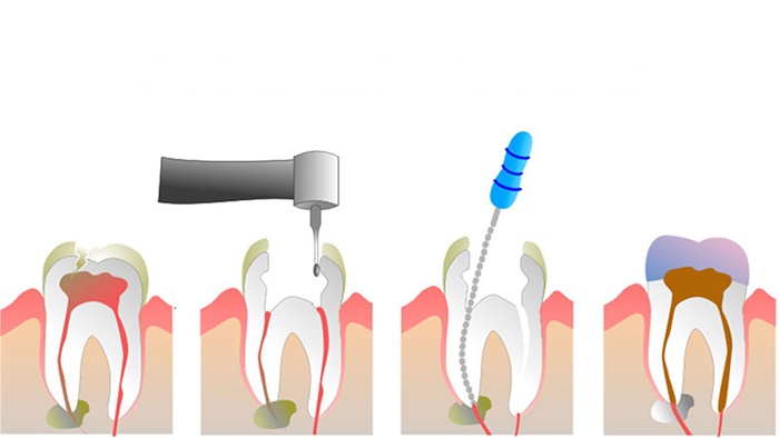 Hình ảnh mô phỏng quá trình lấy tuỷ răng