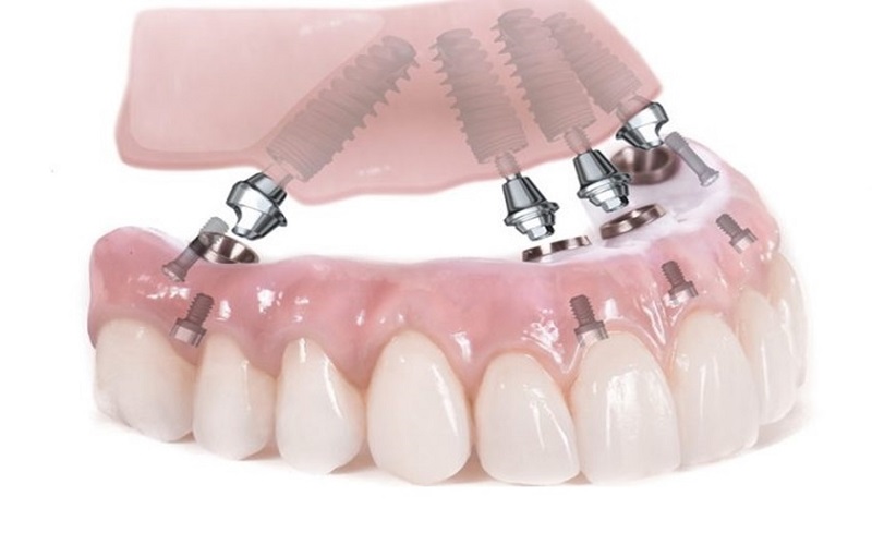 Hình ảnh giới thiệu về Hàm tháo lắp implant