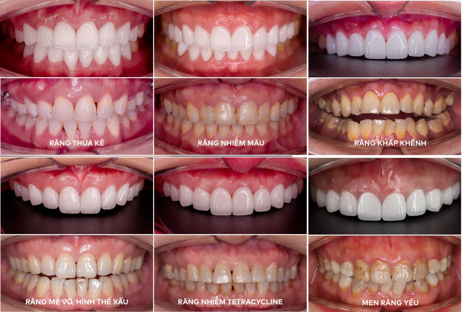Những trường hợp cần dán sứ Veneer Lisi: Nha khoa SV quận 3