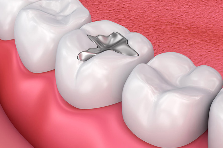 Hình ảnh trám răng bằng Amalgam tại Nha khoa SV quận 3