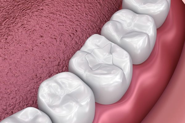 Hình ảnh hình thức trám răng bằng Composite tại nha khoa SV quận 3