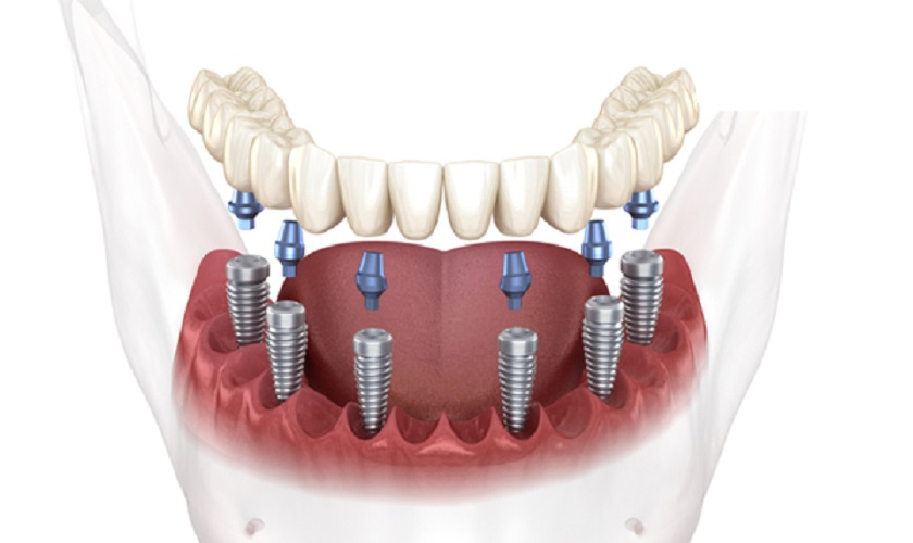Hình ảnh mô phỏng trồng răng Implant All On 6 tại Nha khoa SV quận 3