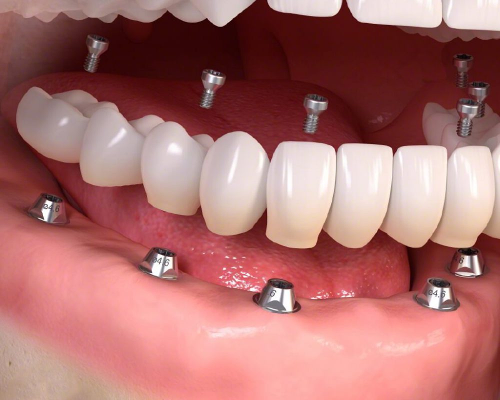 Hình ảnh dịch vụ trồng răng implant tại Nha khoa SV quận 3