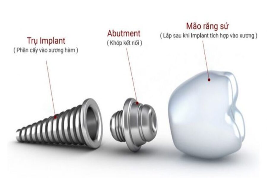 Hình ảnh cấu tạo của răng Implant