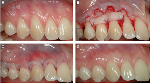 Nạo túi nha chu có nguy hiểm không?