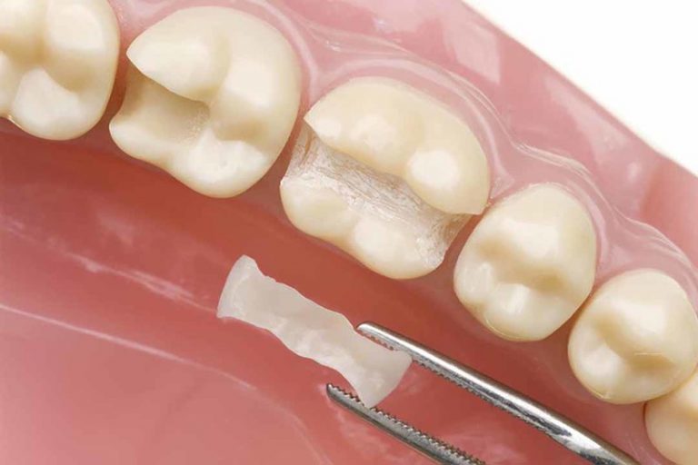 Hình ảnh trám  răng bằng trám kính Lonomer tại nha khoa SV quận 3