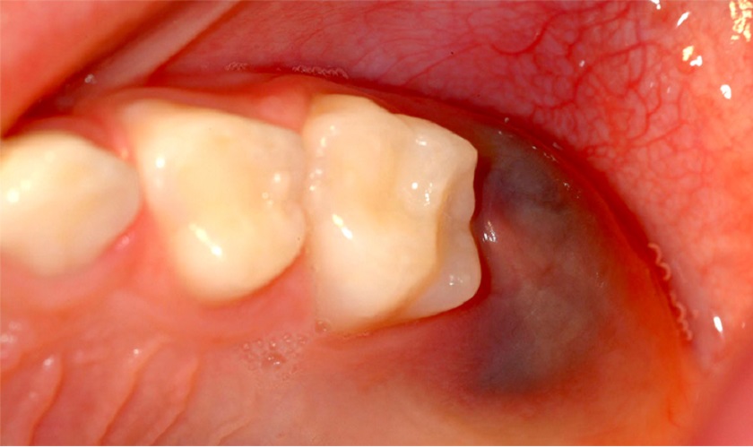 Hình ảnh về dấu hiệu nhận biết bạn đang bị viêm lợi trùm