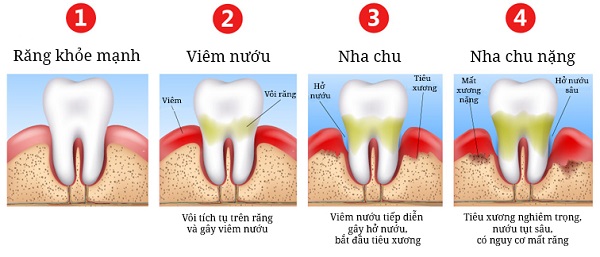 Quá trình hình thành viêm nha chu- Nha khoa SV quận 3