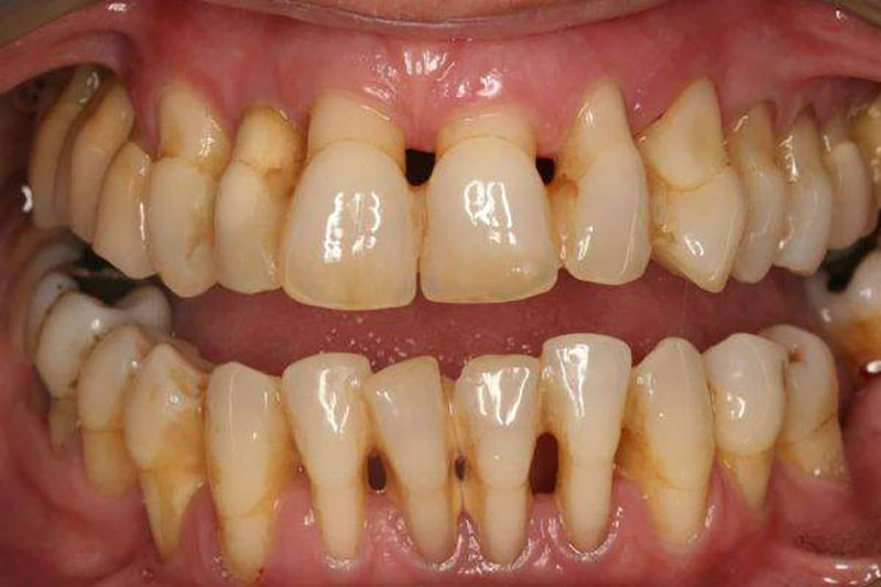 Hình ảnh viêm nha chu mãn tính- Nha khoa SV quận 3