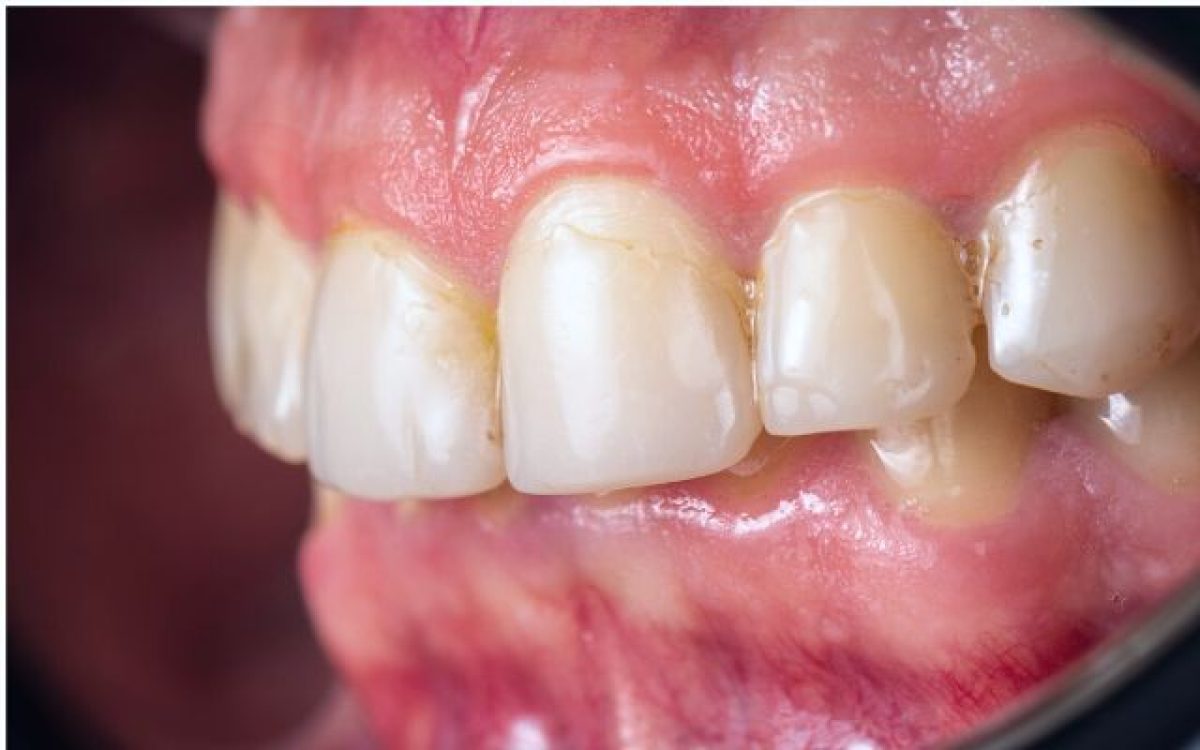Hình ảnh nhiễm màu nội sinh do viêm nướu