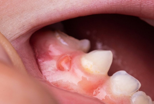 Viêm nướu không được điều trị kịp thời, nó có thể lan rộng và tác động đến tủy răng.