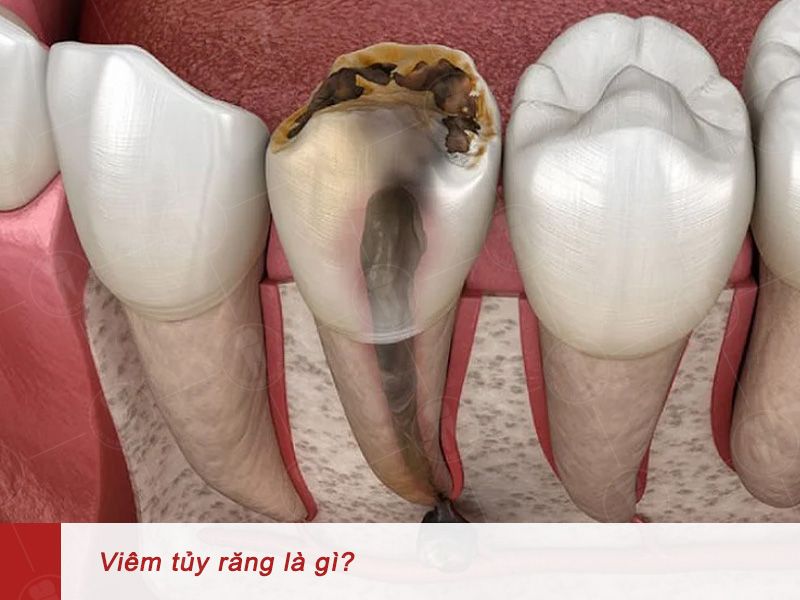 Hình ảnh tuỷ răng bị viêm nặng cần phải điều trị lấy tuỷ răng