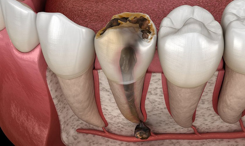 Hình ảnh bị viêm tủy răng của Nha khoa SV quận 3