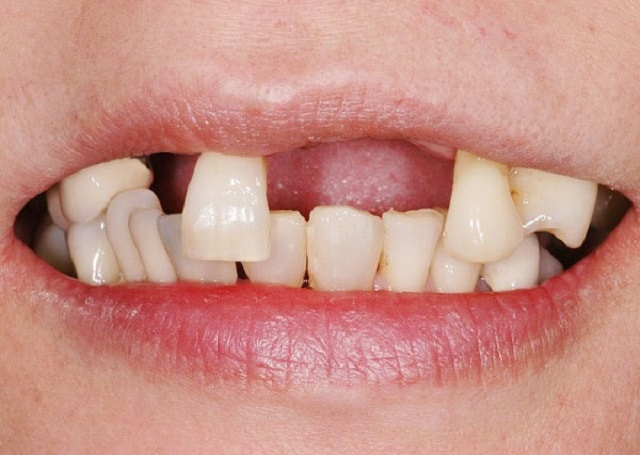 Hình ảnh mất răng ở người già
