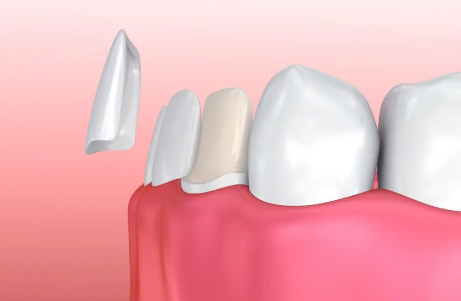 Hình ảnh dịch vụ dán răng sứ Veneers tại quận 3