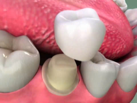 Hình ảnh tròng răng sứ tại quận 3 của nha khoa SV