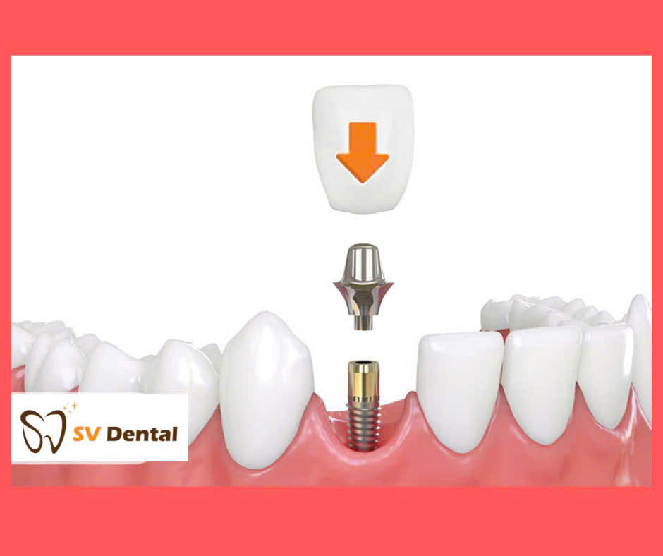 Hình ảnh trồng răng Implant tại nha khoa Sv quận 3