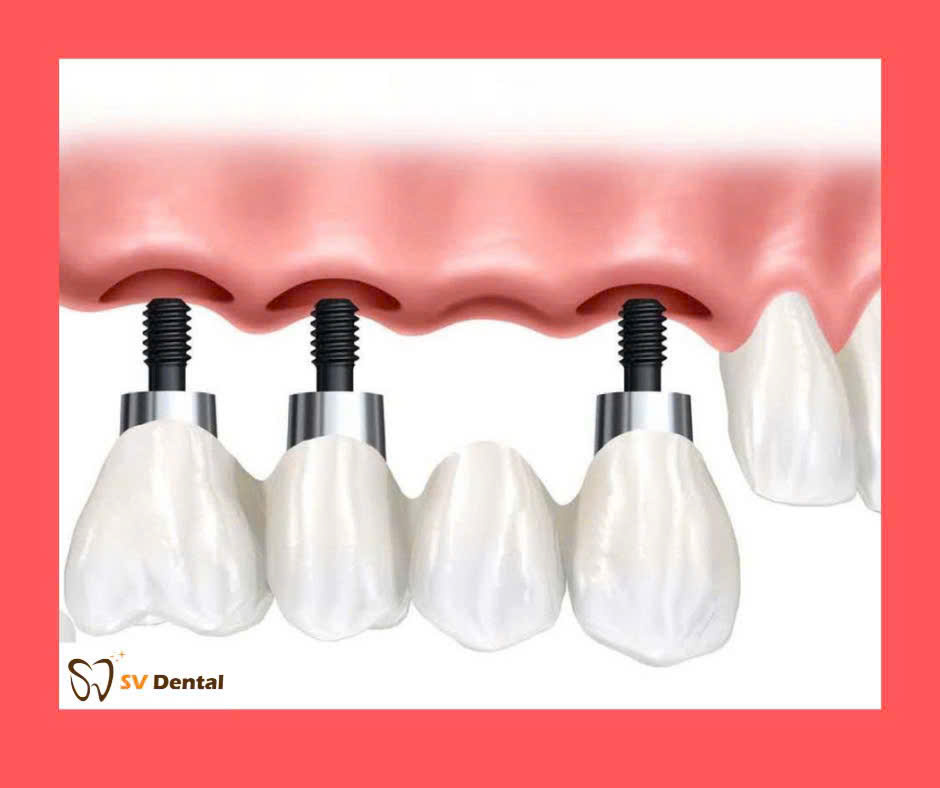 Hình ảnh dịch vụ trồng răng implant tại nha khoa SV quận3
