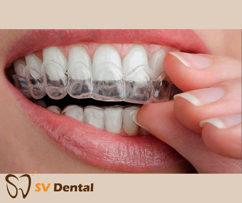 Hình ảnh tẩy trắng răng bằng phương pháp đeo máng tại nhà