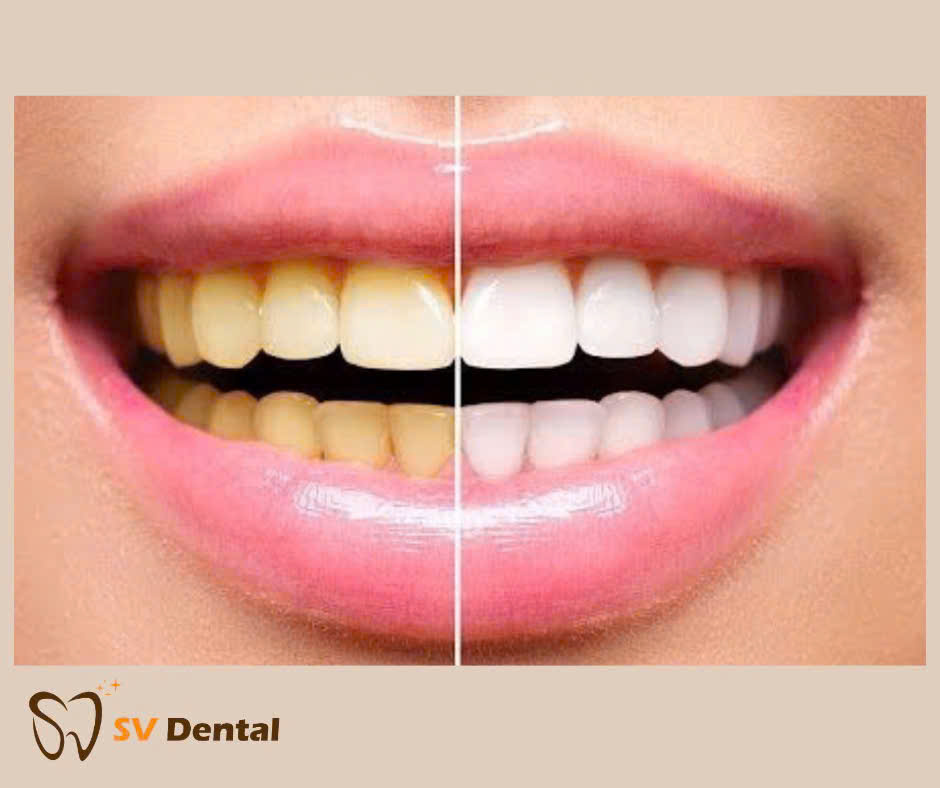 Hình ảnh tẩy trắng răng tại Nha khoa SV quận 3