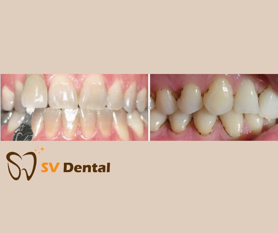 Hình ảnh tẩy trắng răng tại Nha khoa SV quận 3
