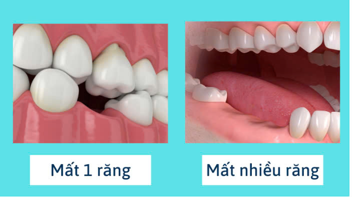 Hình ảnh trồng răng implant tại nha khoa SV quận 3