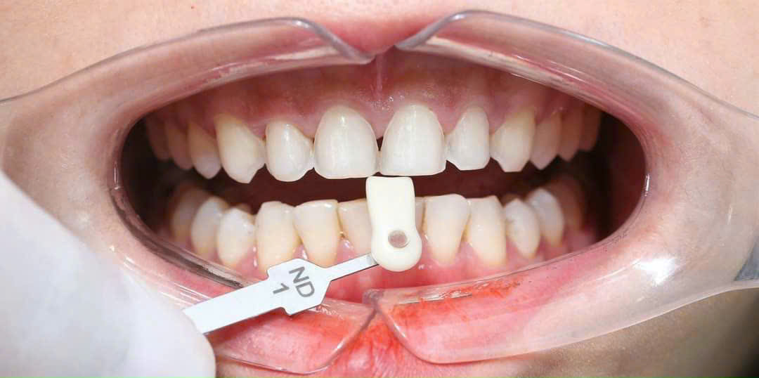 Hình ảnh răng trước khi dán sứ Emax tại Nha khoa SV quận 3