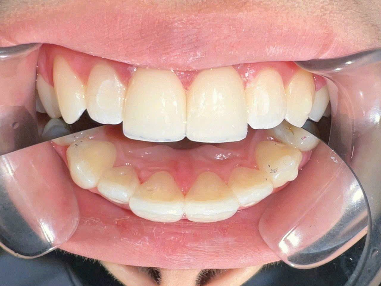 Hình ảnh giới thiệu về thẩm mỹ răng sứ