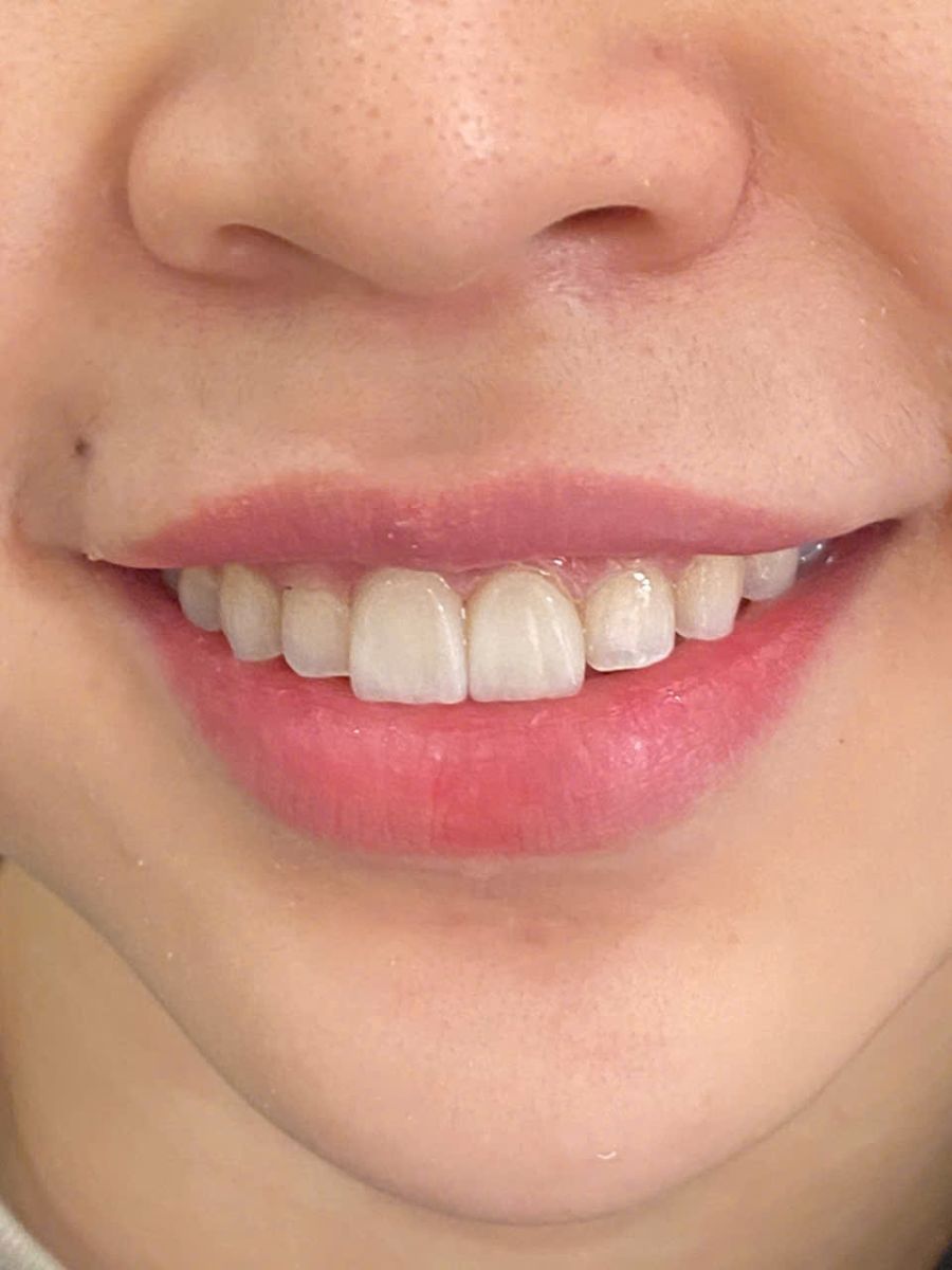 Hình ảnh dán sứ Veneer Emax tại Nha khoa Sv quận 3