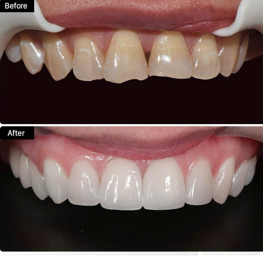 Hình ảnh dịch vụ mặt dán sứ Veneer Emax tại nha khoa SV quận 3