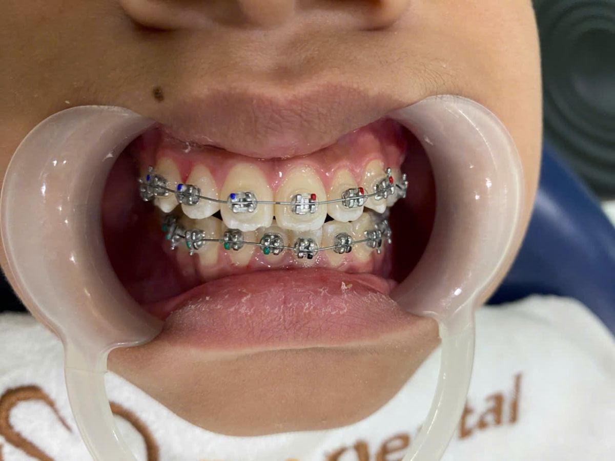 Hình ảnh điều trị niềng răng tại Nha khoa SV quận 3 