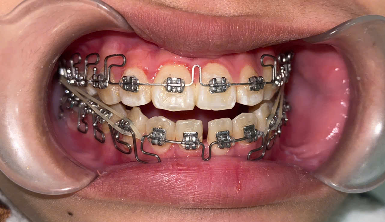 Hình ảnh niềng răng mắc cài kim loại tại Nha khoa SV quận 3