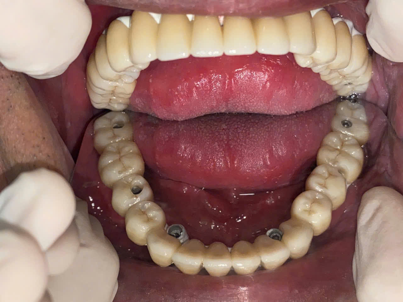 Nha khoa SV quận 3: địa chỉ trồng răng implant uy tín cho người lớn tuổi 